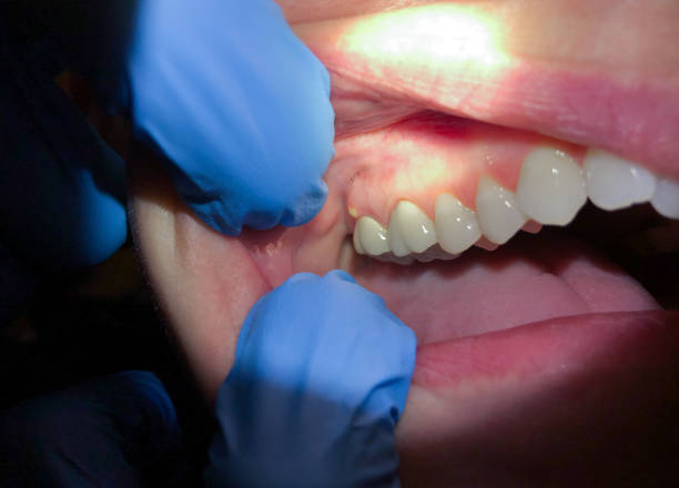 Best Emergency Care for Gum Disease in Brookville, OH